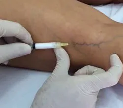Escleroterapia: saiba tudo sobre o tratamento de varizes 2 Escleroterapia - Aplicação nas varizes