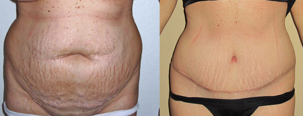 Abdominoplastia antes e depois - foto 1