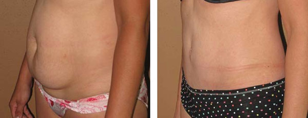 Abdominoplastia antes e depois - foto 2