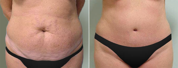 Abdominoplastia antes e depois - foto 3