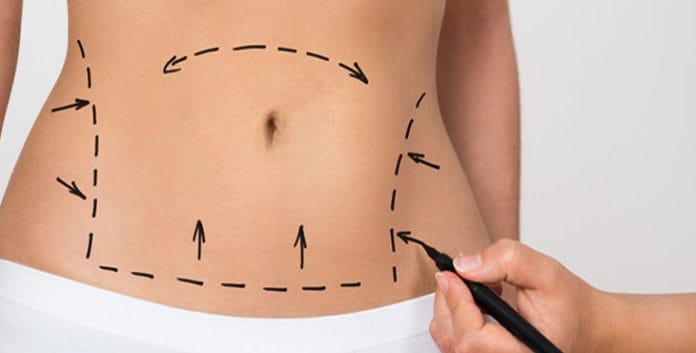 Abdominoplastia: a cirurgia plástica da barriga